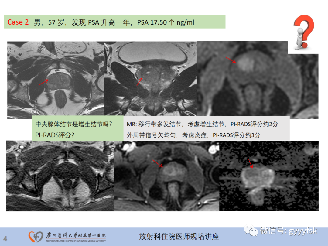 影像PPT - 【PPT】前列腺癌的MR扫描规范及精准诊断-5