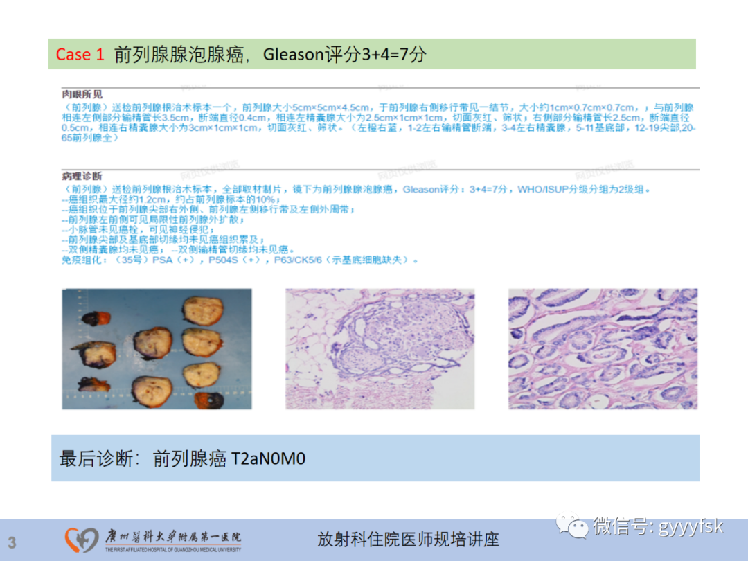 影像PPT - 【PPT】前列腺癌的MR扫描规范及精准诊断-4
