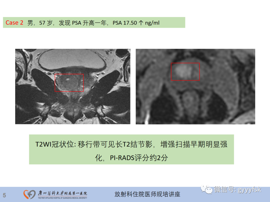 影像PPT - 【PPT】前列腺癌的MR扫描规范及精准诊断-6