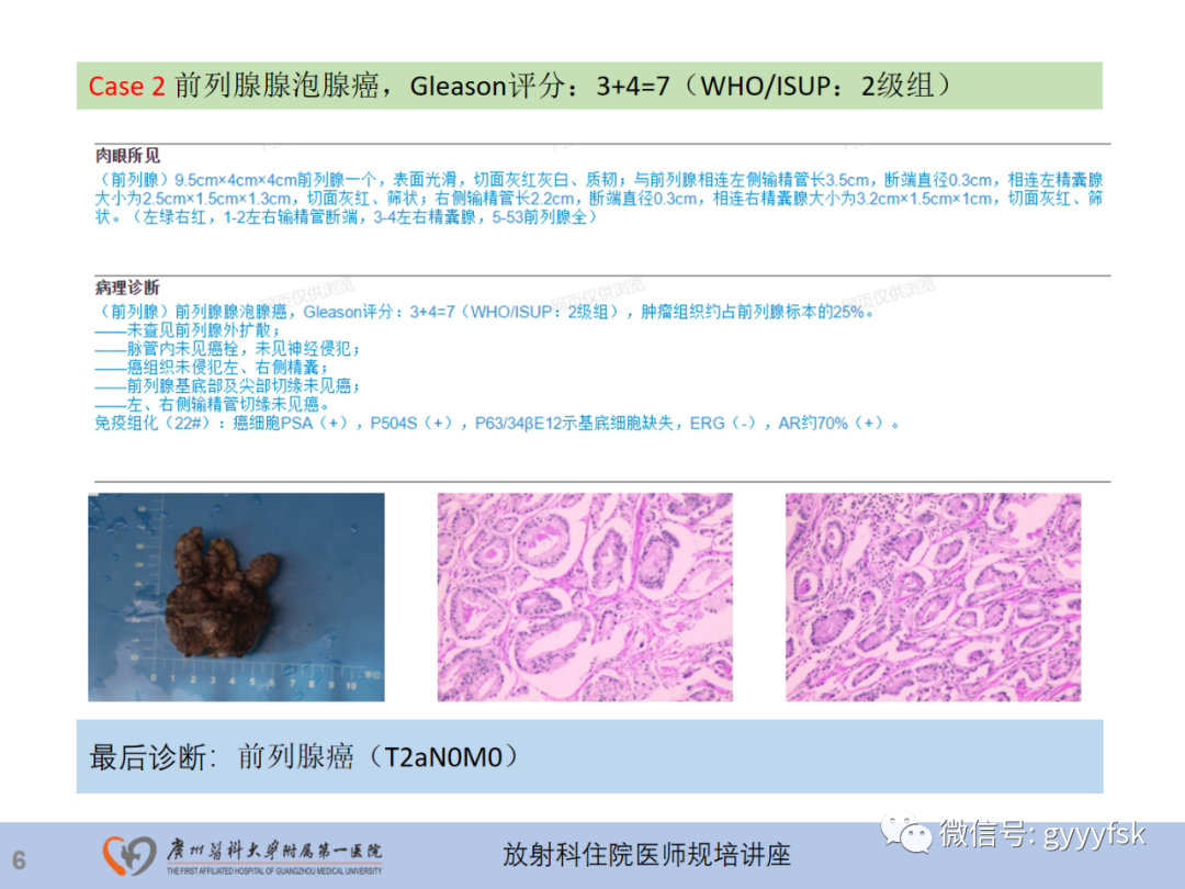 影像PPT - 【PPT】前列腺癌的MR扫描规范及精准诊断-7