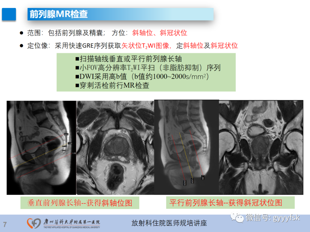 影像PPT - 【PPT】前列腺癌的MR扫描规范及精准诊断-8