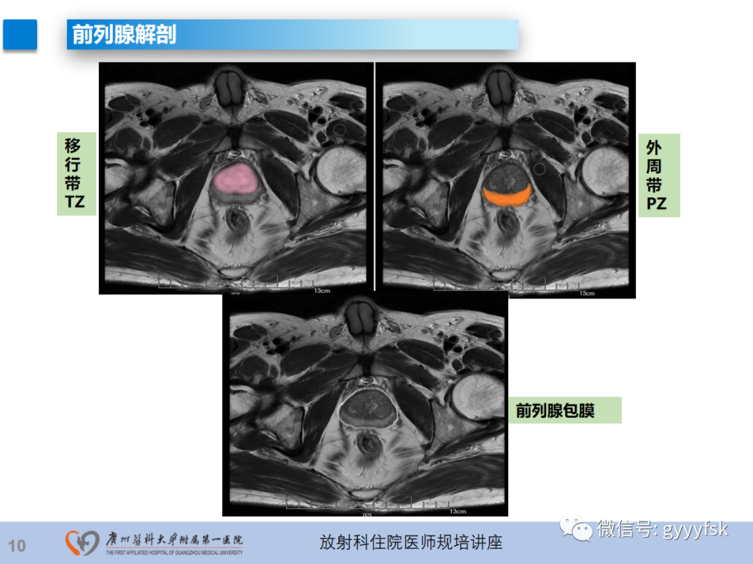 影像PPT - 【PPT】前列腺癌的MR扫描规范及精准诊断-11