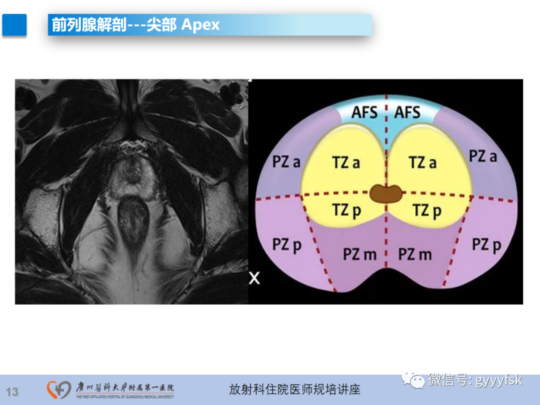 影像PPT - 【PPT】前列腺癌的MR扫描规范及精准诊断-14