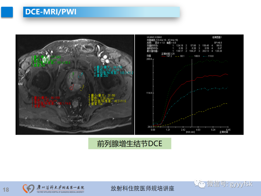影像PPT - 【PPT】前列腺癌的MR扫描规范及精准诊断-19