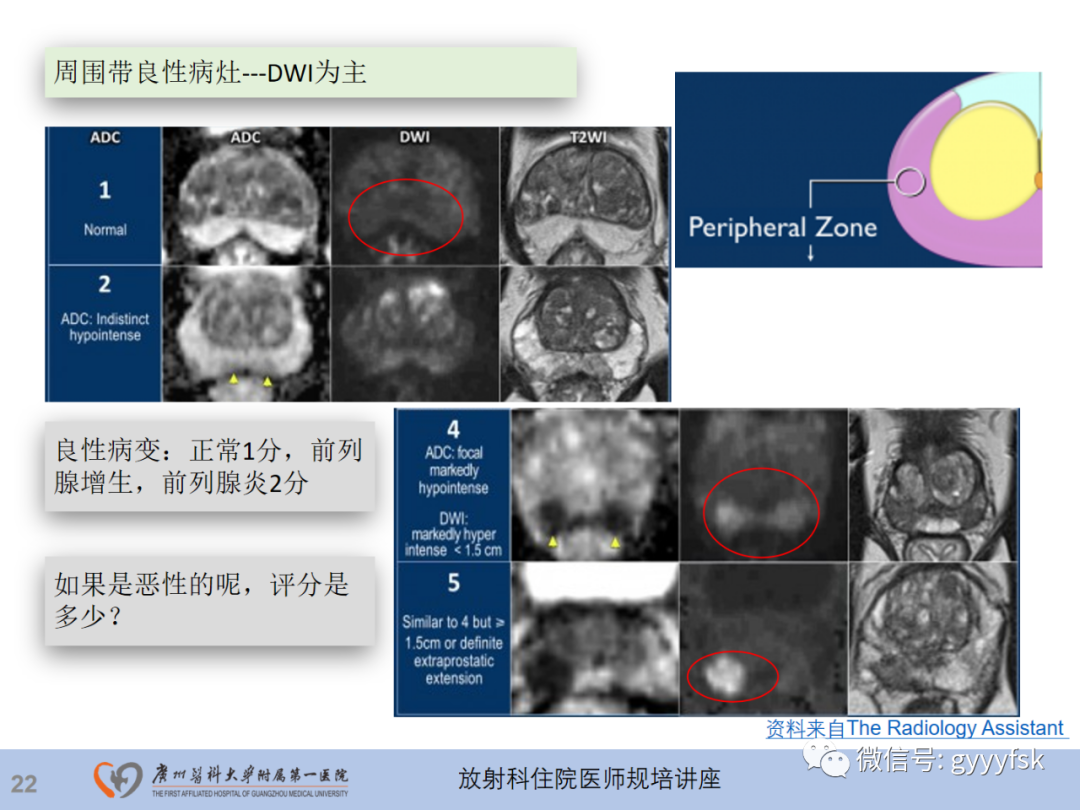 影像PPT - 【PPT】前列腺癌的MR扫描规范及精准诊断-23