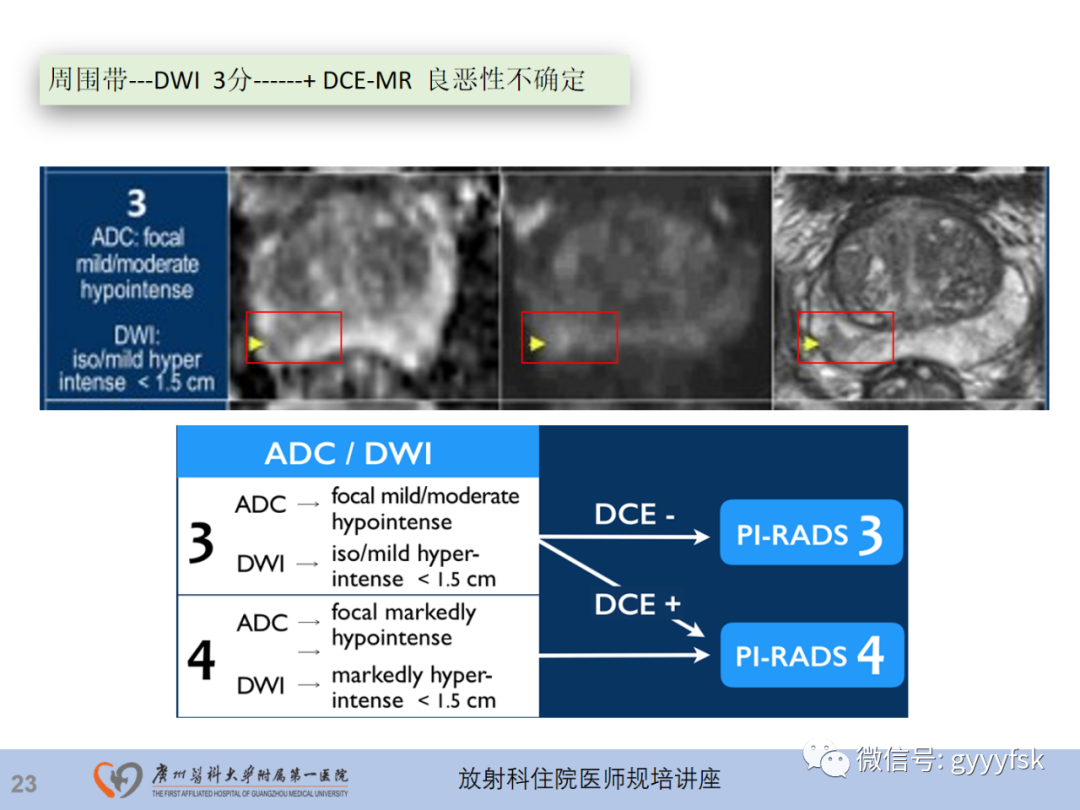 影像PPT - 【PPT】前列腺癌的MR扫描规范及精准诊断-24