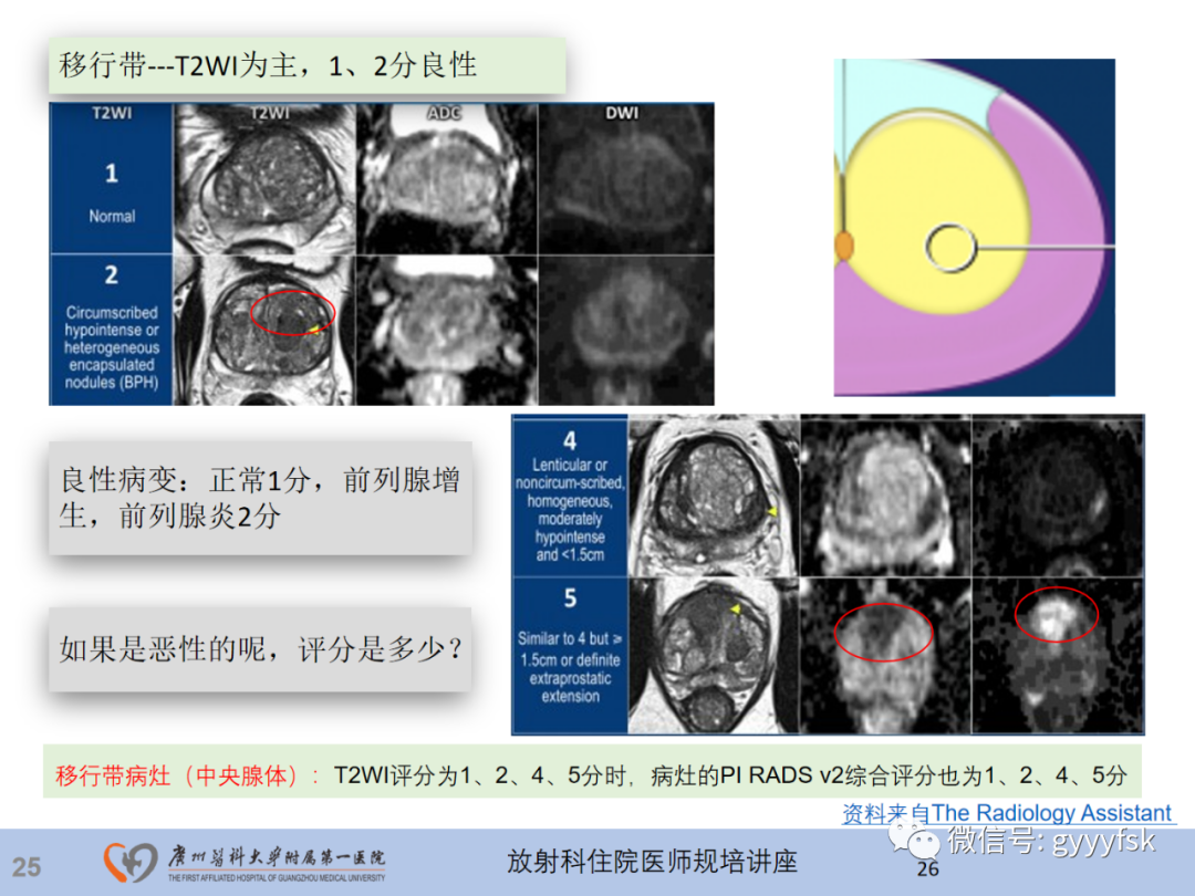 影像PPT - 【PPT】前列腺癌的MR扫描规范及精准诊断-26