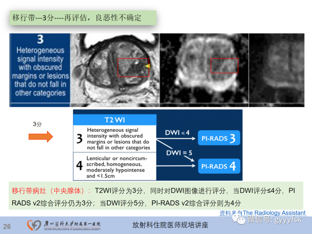 影像PPT - 【PPT】前列腺癌的MR扫描规范及精准诊断-27