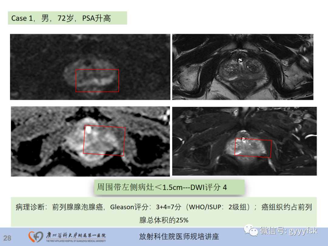影像PPT - 【PPT】前列腺癌的MR扫描规范及精准诊断-29