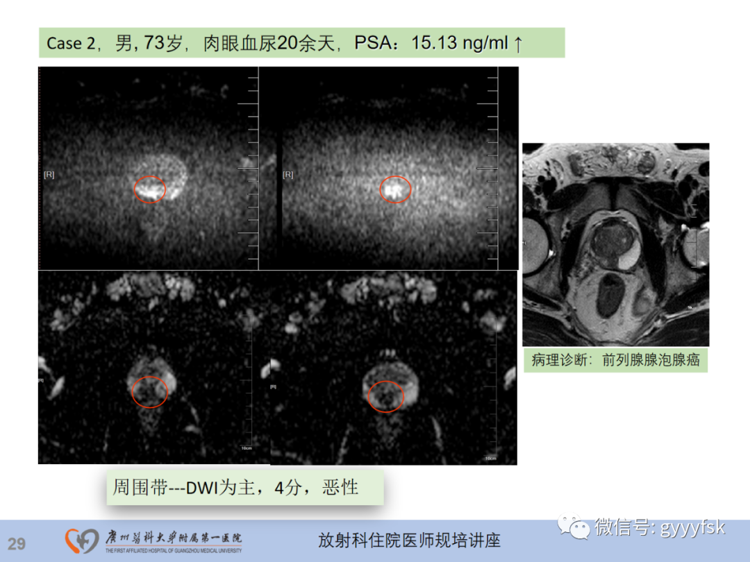 影像PPT - 【PPT】前列腺癌的MR扫描规范及精准诊断-30