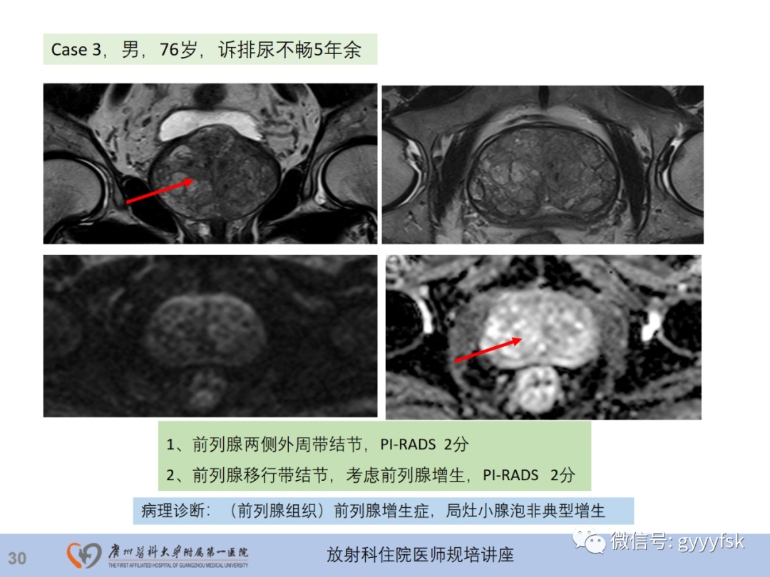 影像PPT - 【PPT】前列腺癌的MR扫描规范及精准诊断-31