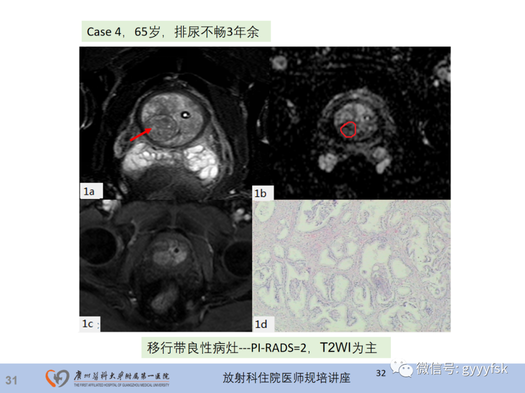 影像PPT - 【PPT】前列腺癌的MR扫描规范及精准诊断-32