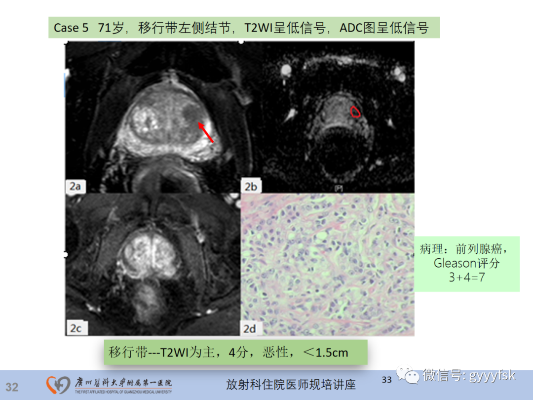影像PPT - 【PPT】前列腺癌的MR扫描规范及精准诊断-33