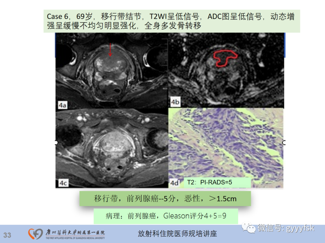 影像PPT - 【PPT】前列腺癌的MR扫描规范及精准诊断-34