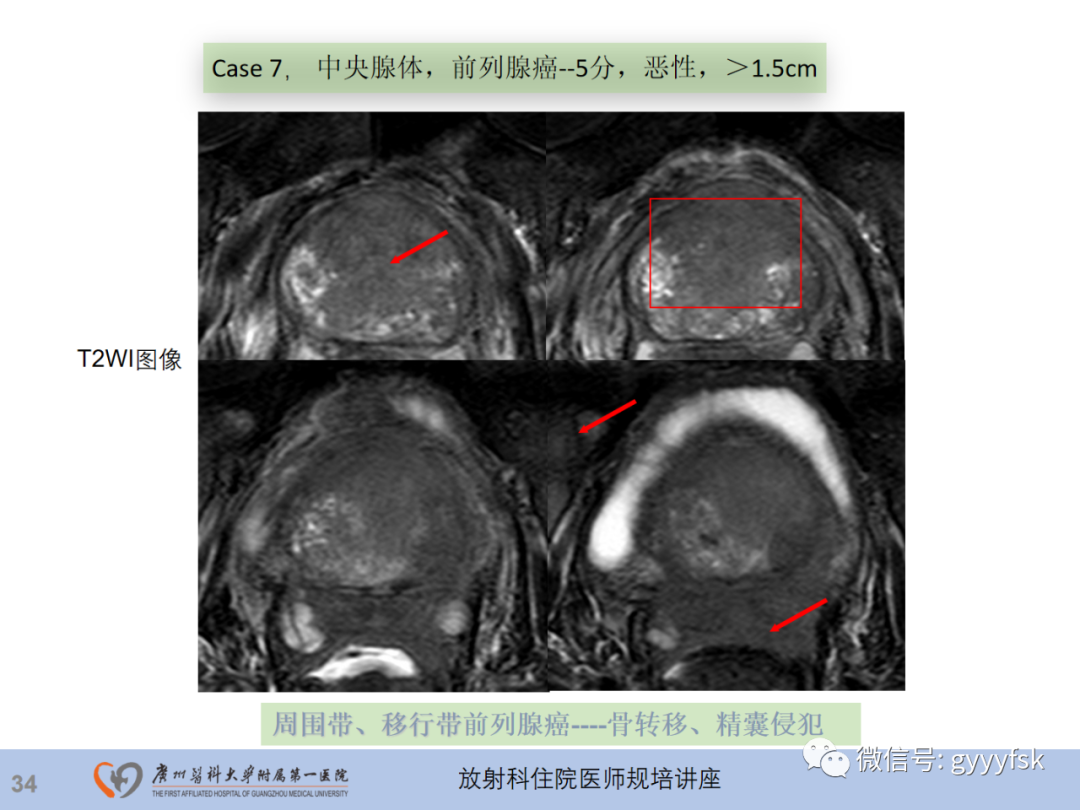 影像PPT - 【PPT】前列腺癌的MR扫描规范及精准诊断-35