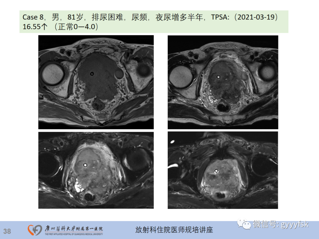 影像PPT - 【PPT】前列腺癌的MR扫描规范及精准诊断-39