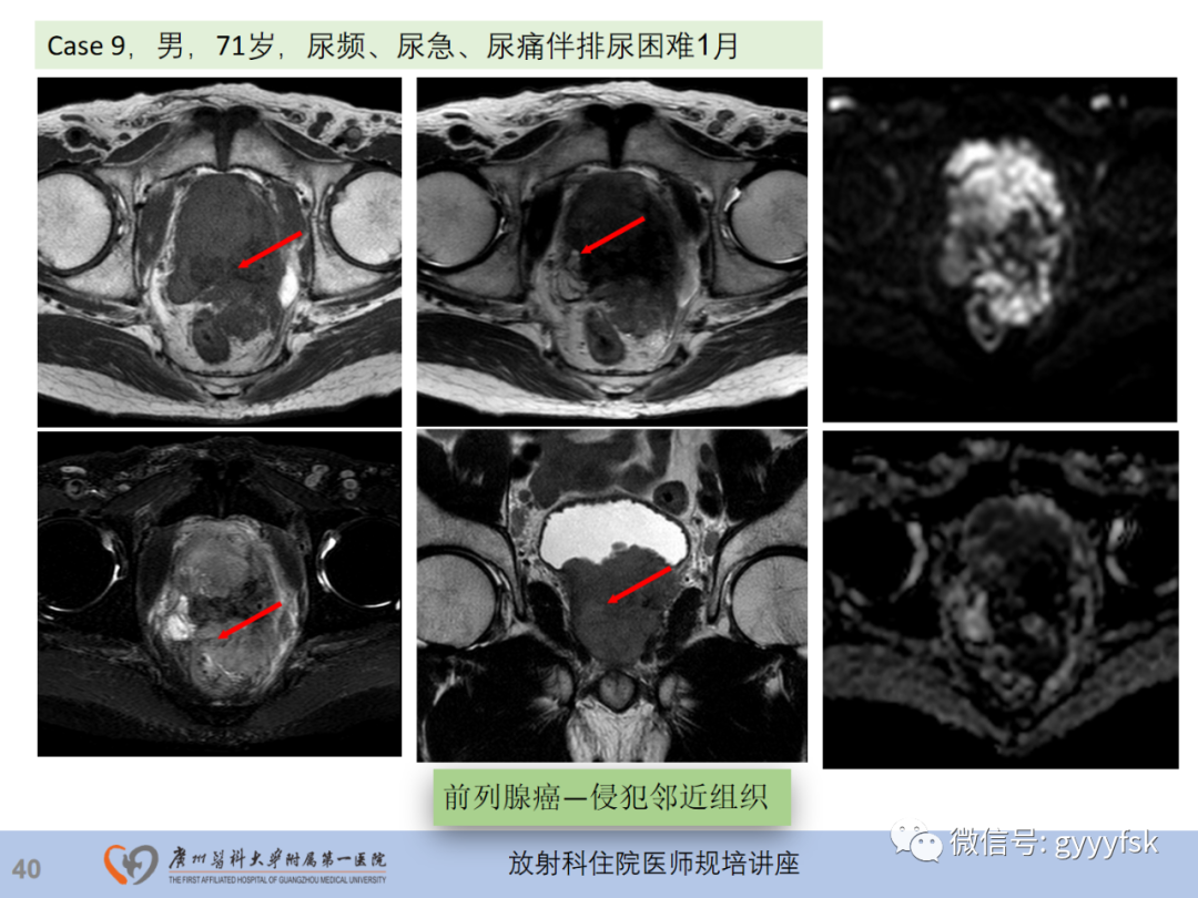 影像PPT - 【PPT】前列腺癌的MR扫描规范及精准诊断-41
