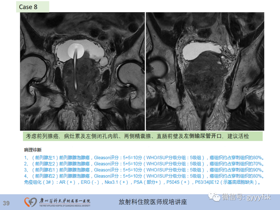 影像PPT - 【PPT】前列腺癌的MR扫描规范及精准诊断-40