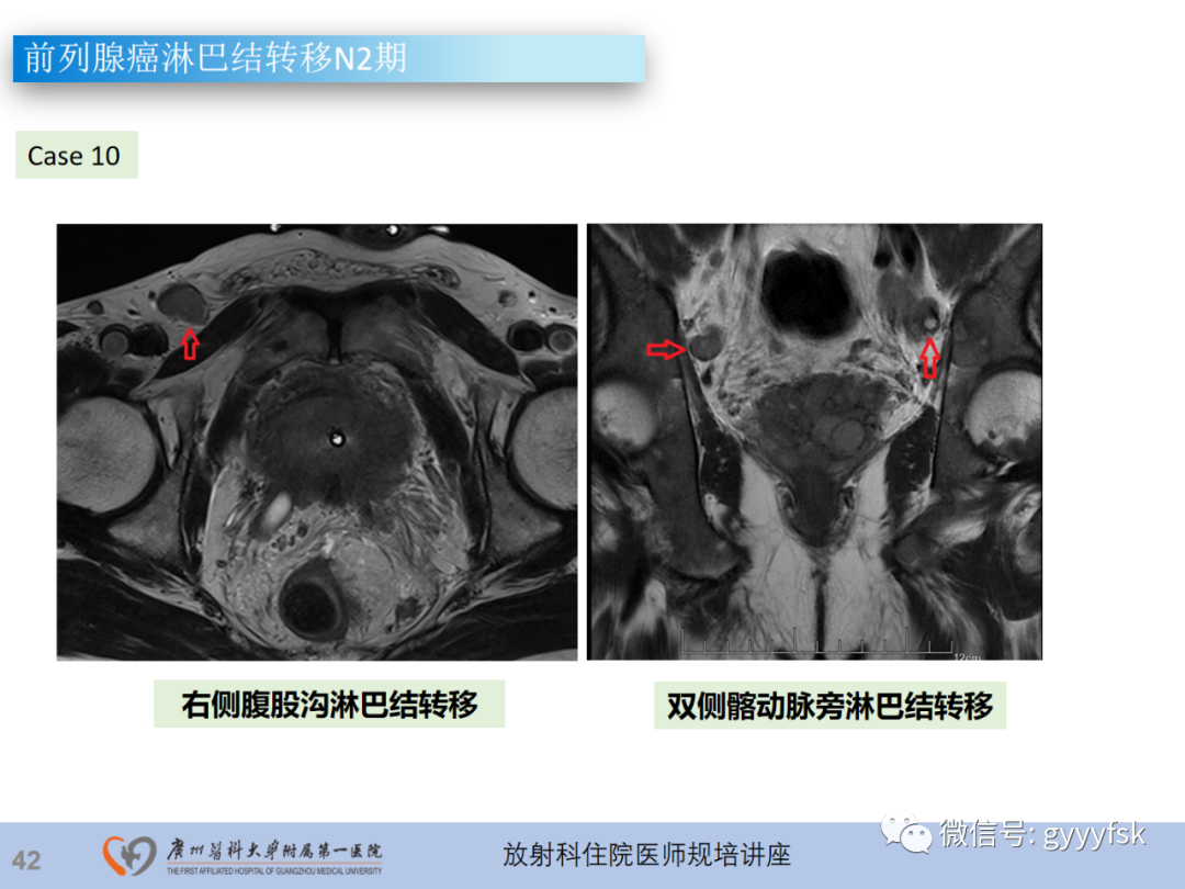 影像PPT - 【PPT】前列腺癌的MR扫描规范及精准诊断-43