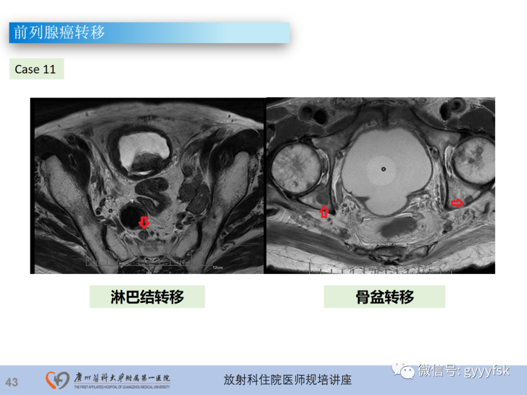 影像PPT - 【PPT】前列腺癌的MR扫描规范及精准诊断-44