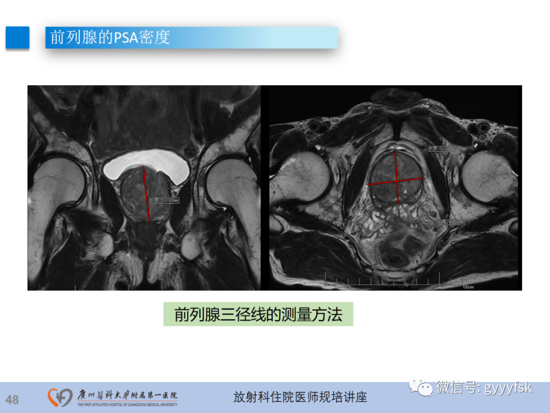 影像PPT - 【PPT】前列腺癌的MR扫描规范及精准诊断-49