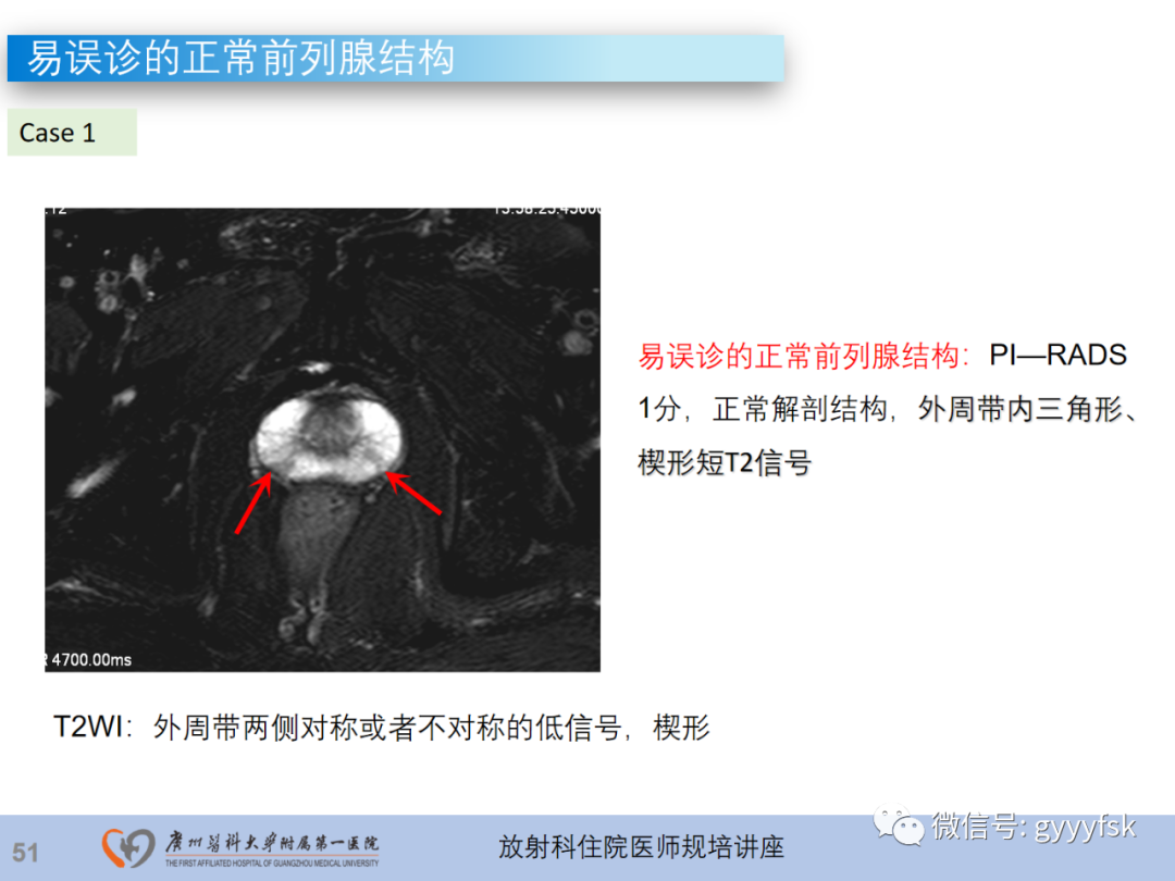 影像PPT - 【PPT】前列腺癌的MR扫描规范及精准诊断-52