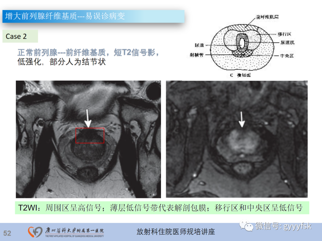 影像PPT - 【PPT】前列腺癌的MR扫描规范及精准诊断-53