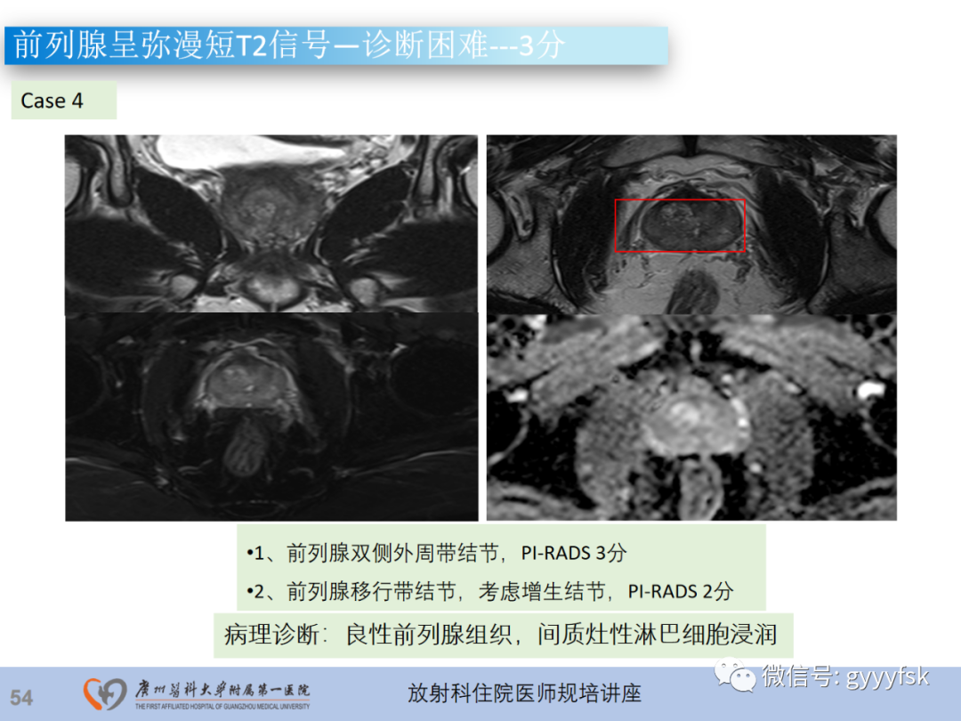 影像PPT - 【PPT】前列腺癌的MR扫描规范及精准诊断-55