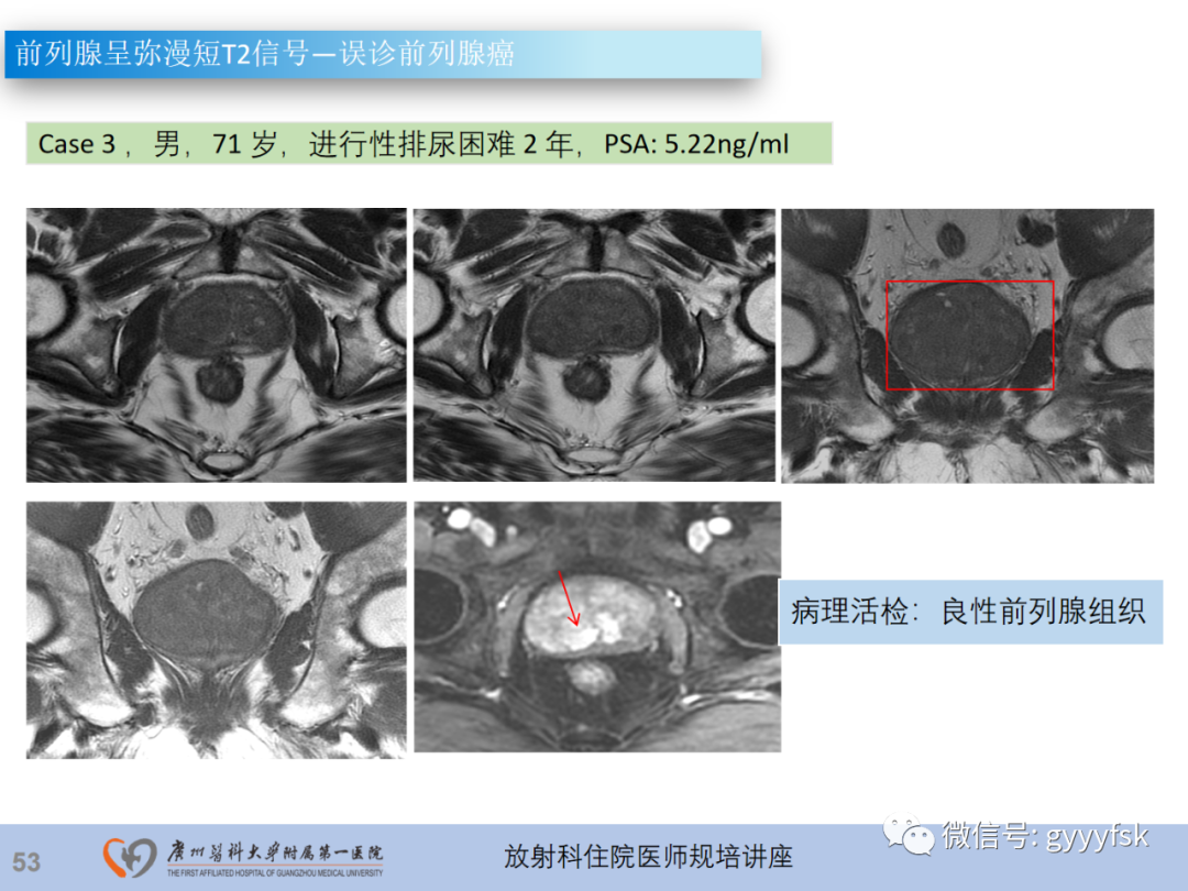 影像PPT - 【PPT】前列腺癌的MR扫描规范及精准诊断-54
