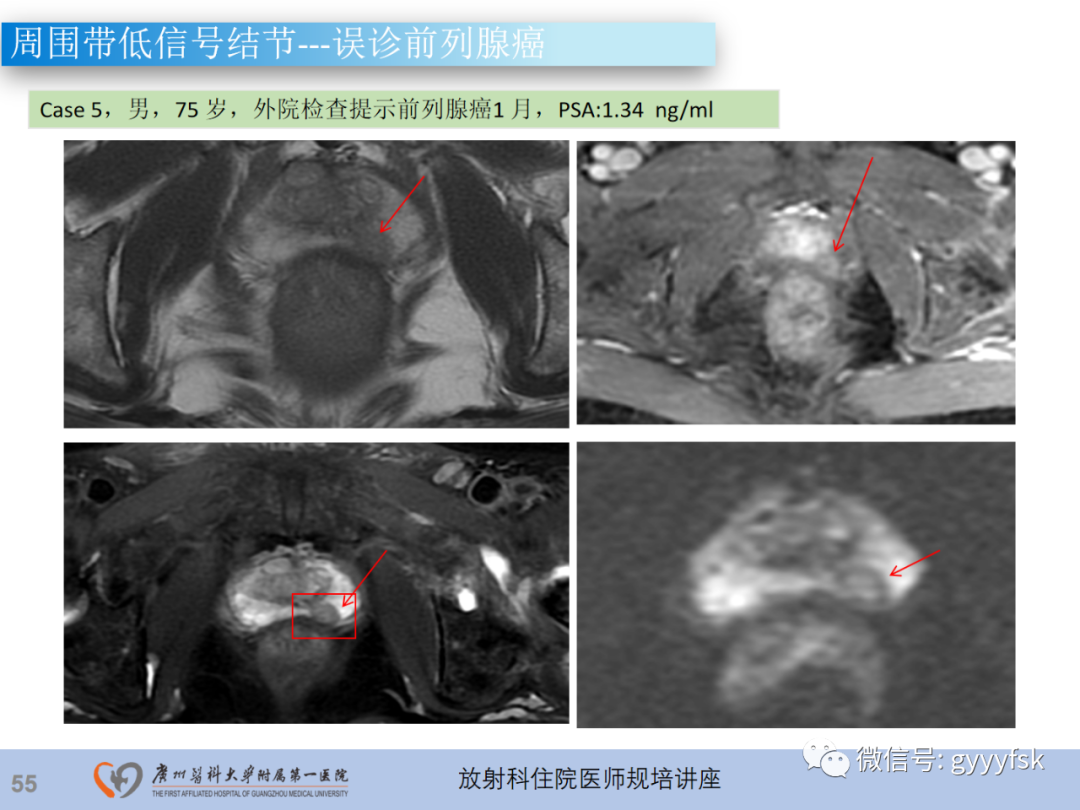 影像PPT - 【PPT】前列腺癌的MR扫描规范及精准诊断-56