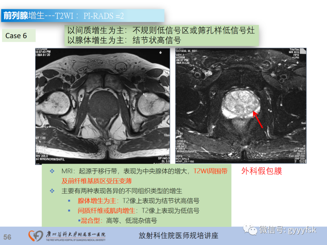影像PPT - 【PPT】前列腺癌的MR扫描规范及精准诊断-57
