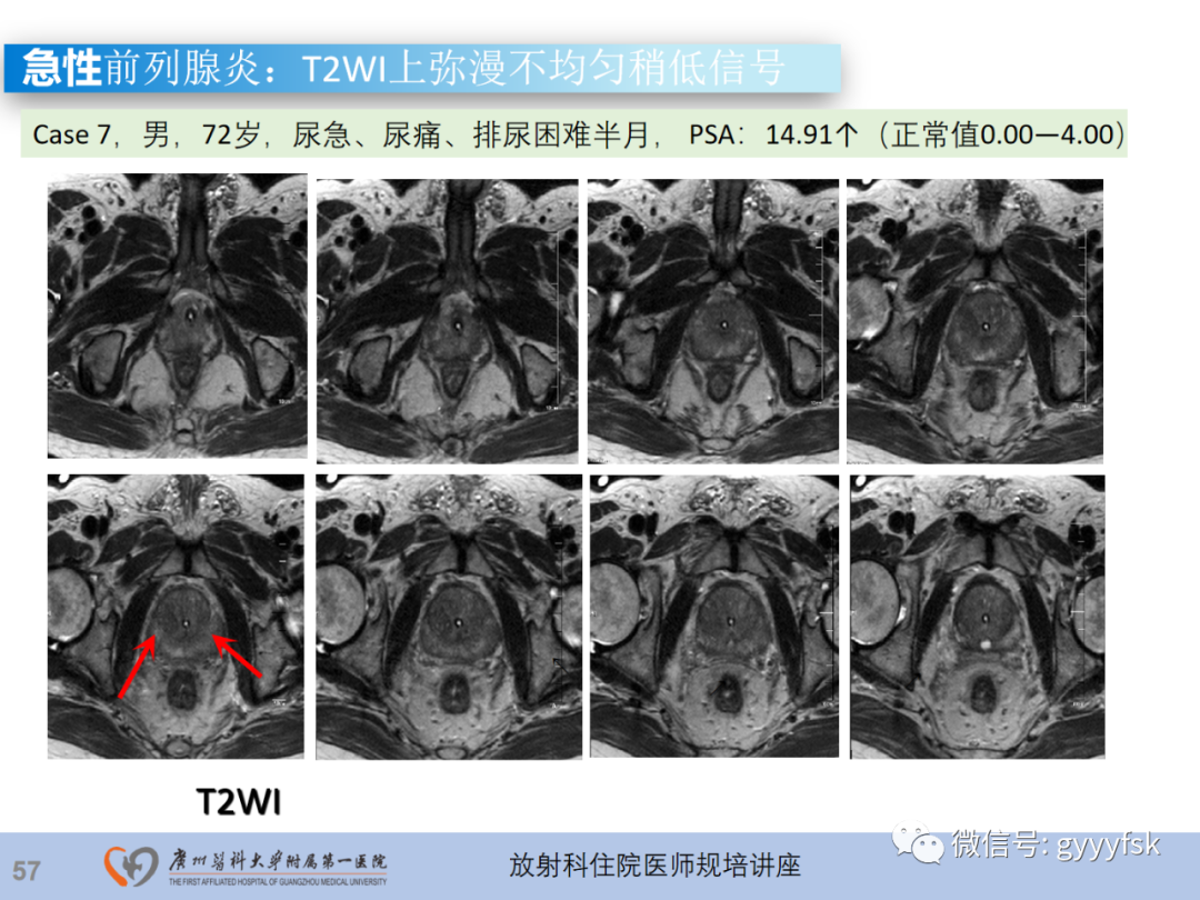 影像PPT - 【PPT】前列腺癌的MR扫描规范及精准诊断-58