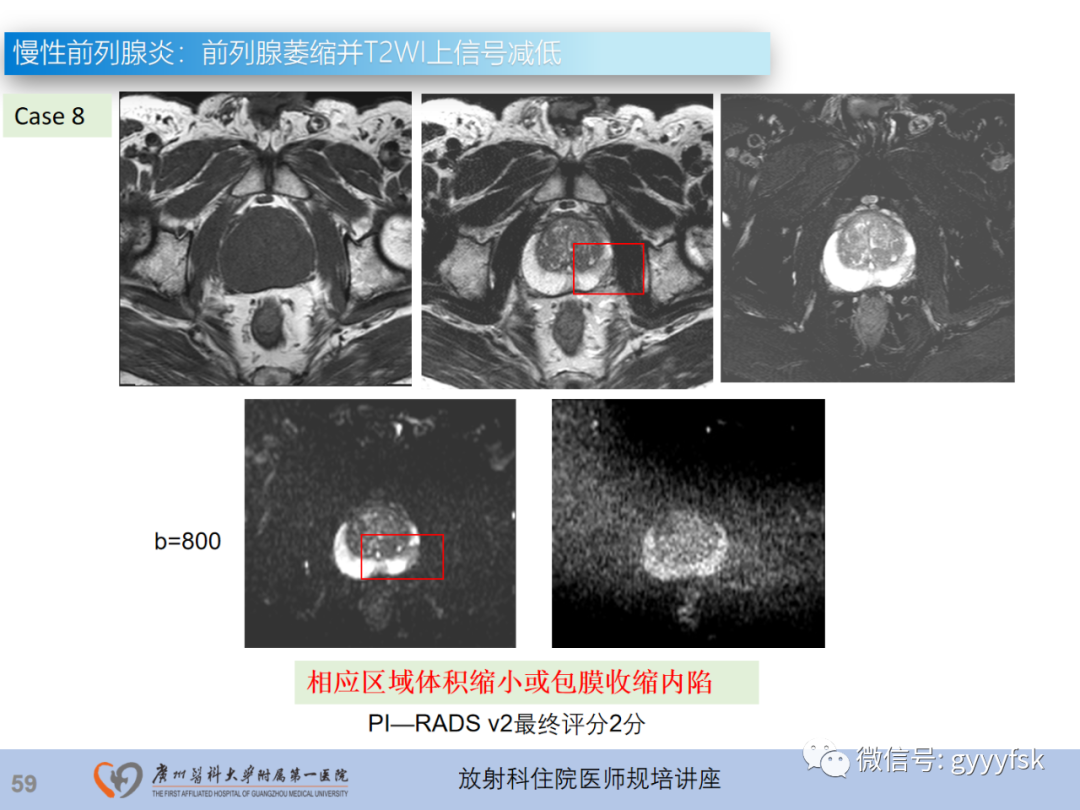影像PPT - 【PPT】前列腺癌的MR扫描规范及精准诊断-60