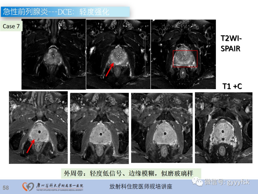 影像PPT - 【PPT】前列腺癌的MR扫描规范及精准诊断-59