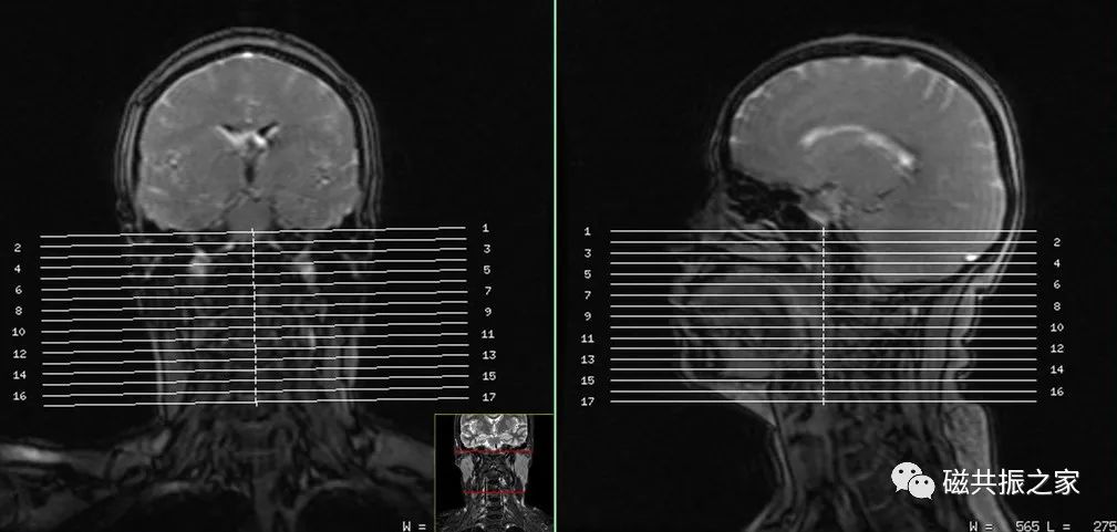 影像PPT - 腮腺MRI该如何扫描-2 影像PPT - 腮腺MRI该如何扫描-2