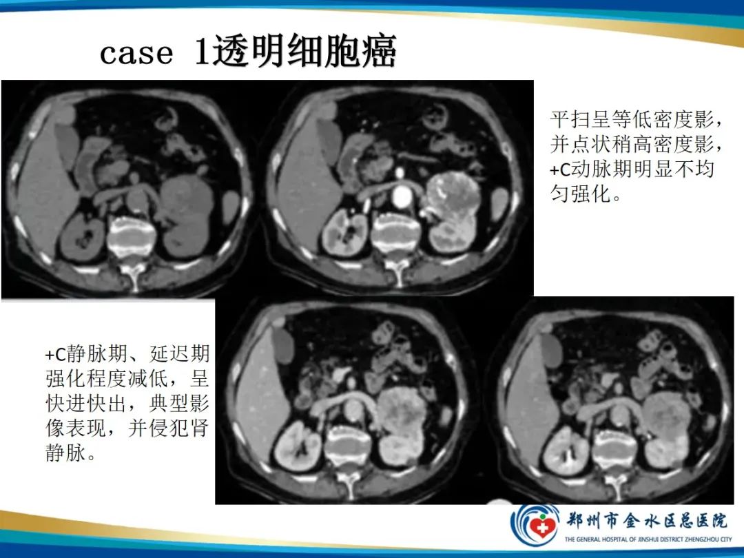 影像PPT - 【PPT】肾细胞癌-5
