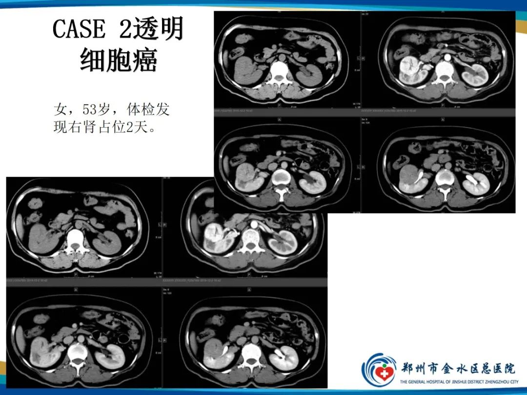 影像PPT - 【PPT】肾细胞癌-6