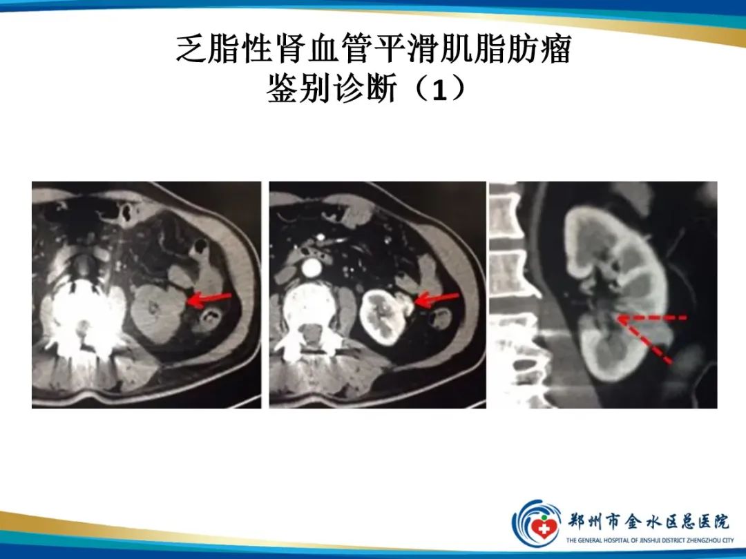 影像PPT - 【PPT】肾细胞癌-8