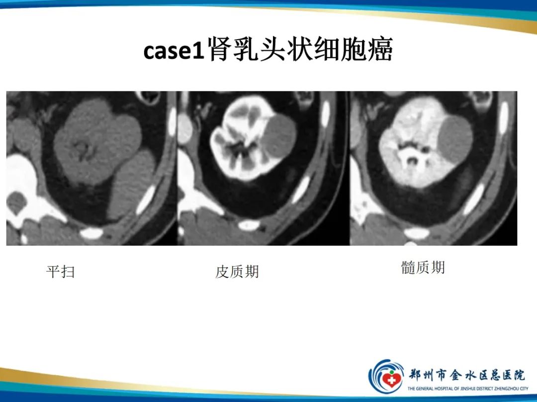 影像PPT - 【PPT】肾细胞癌-10