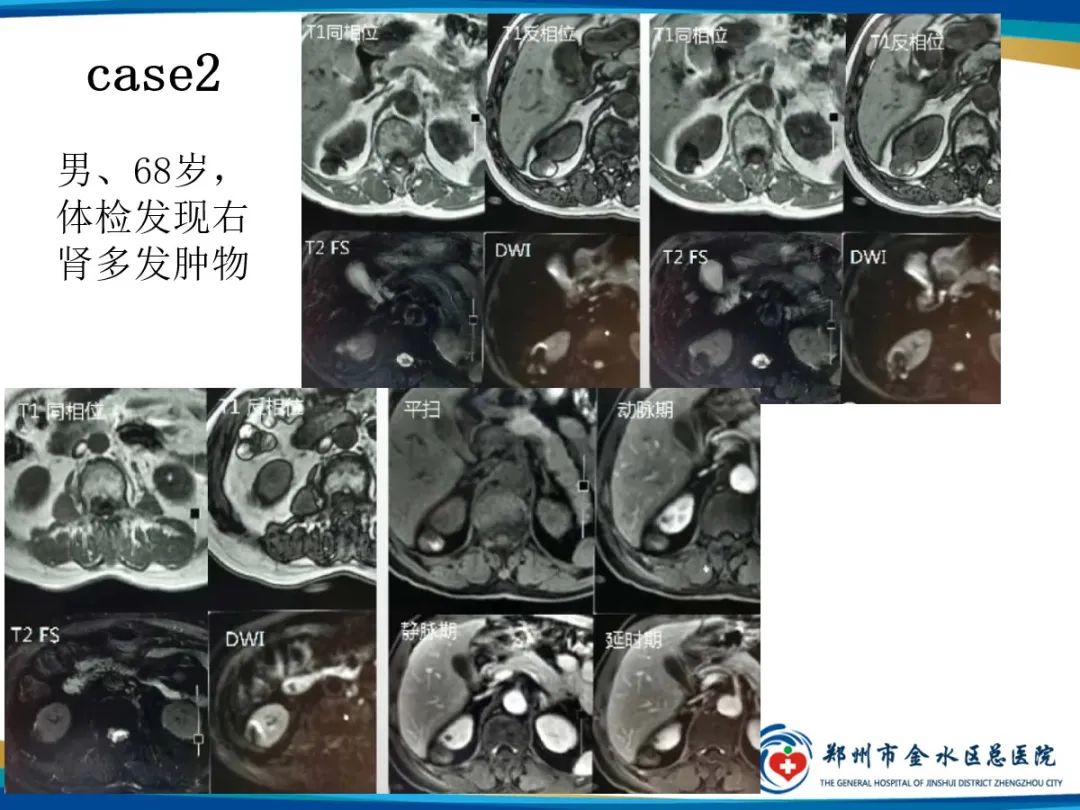 影像PPT - 【PPT】肾细胞癌-11