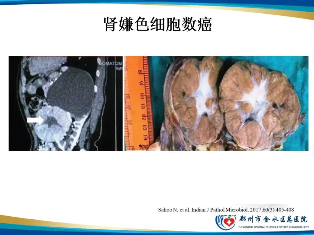 影像PPT - 【PPT】肾细胞癌-13