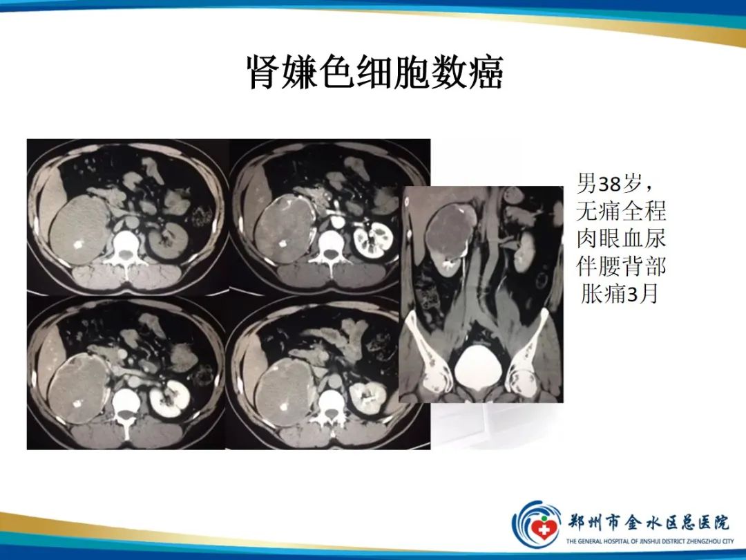 影像PPT - 【PPT】肾细胞癌-14
