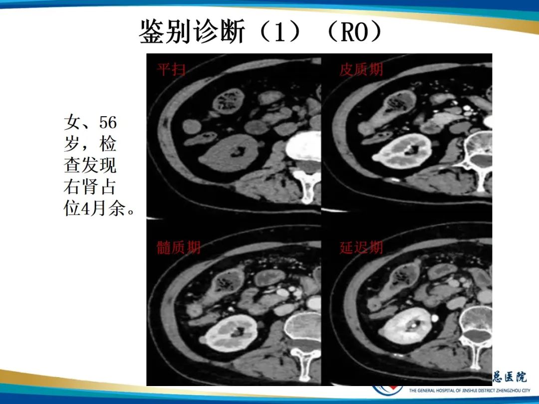 影像PPT - 【PPT】肾细胞癌-16