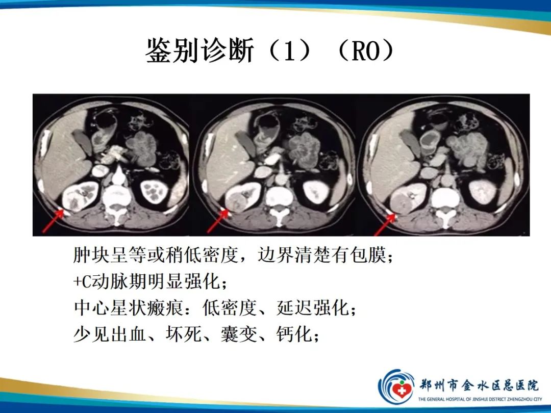 影像PPT - 【PPT】肾细胞癌-17