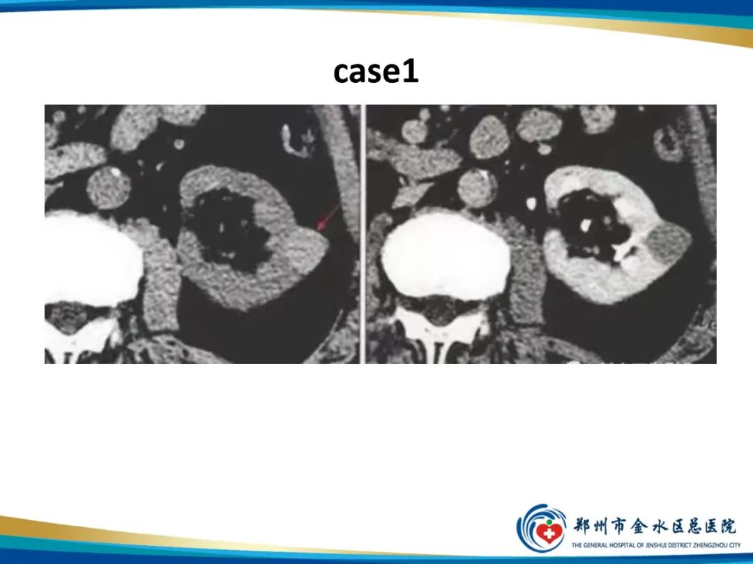 影像PPT - 【PPT】肾细胞癌-19