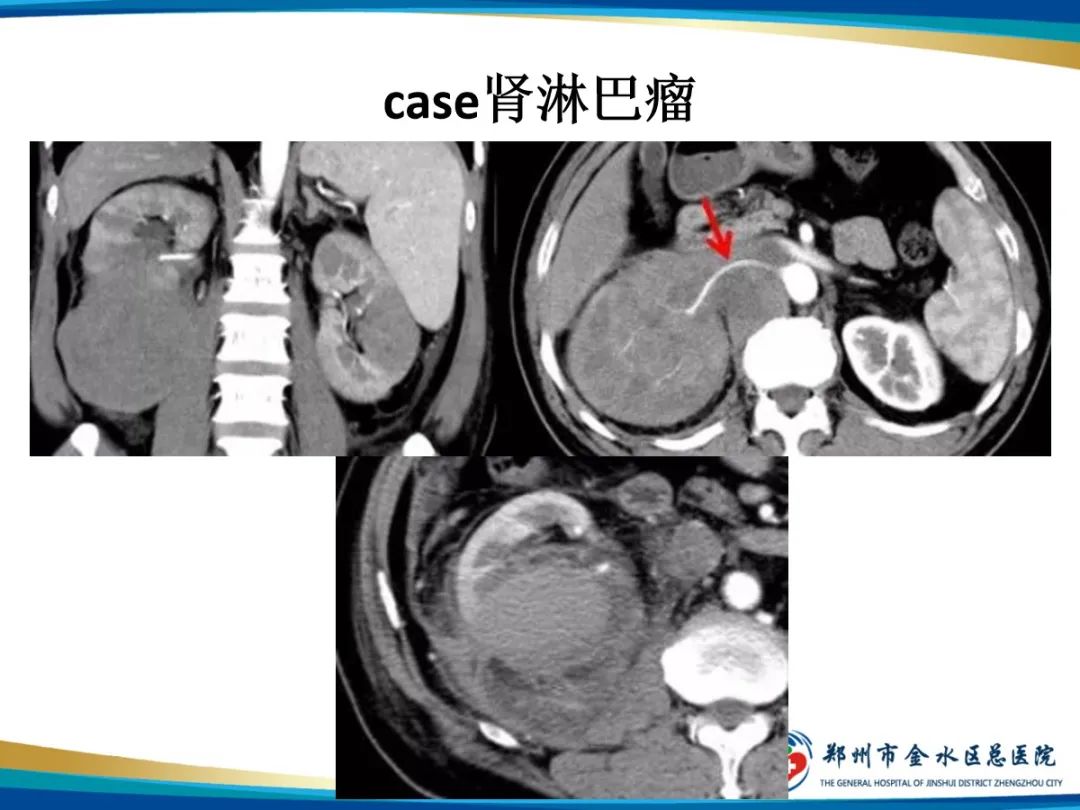影像PPT - 【PPT】肾细胞癌-23