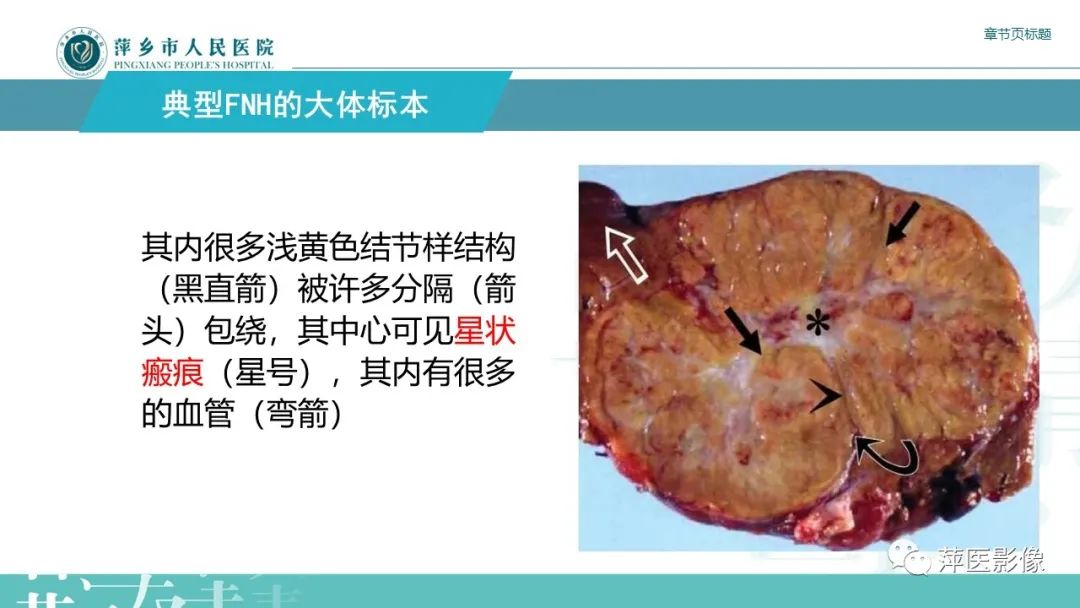 影像PPT - 【PPT】肝脏局灶性结节性增生(FNH)-9