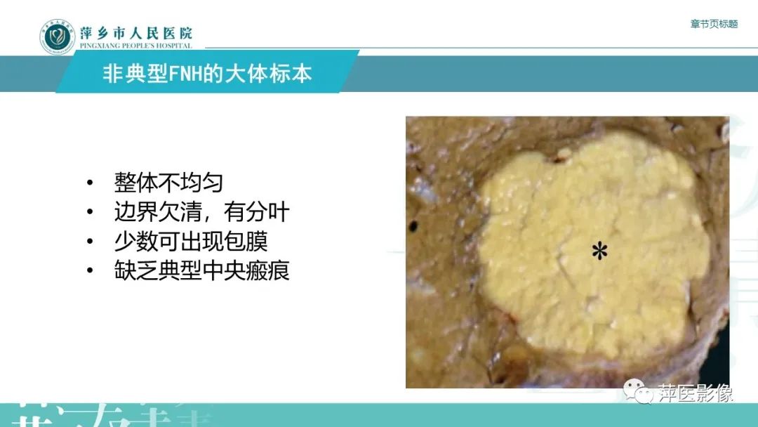 影像PPT - 【PPT】肝脏局灶性结节性增生(FNH)-11