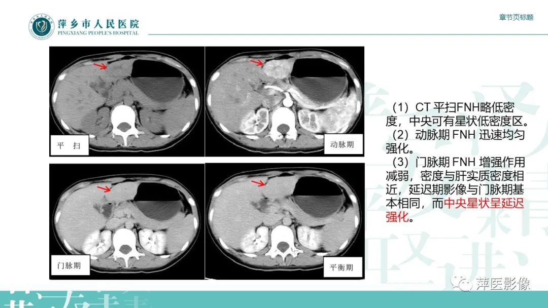 影像PPT - 【PPT】肝脏局灶性结节性增生(FNH)-14