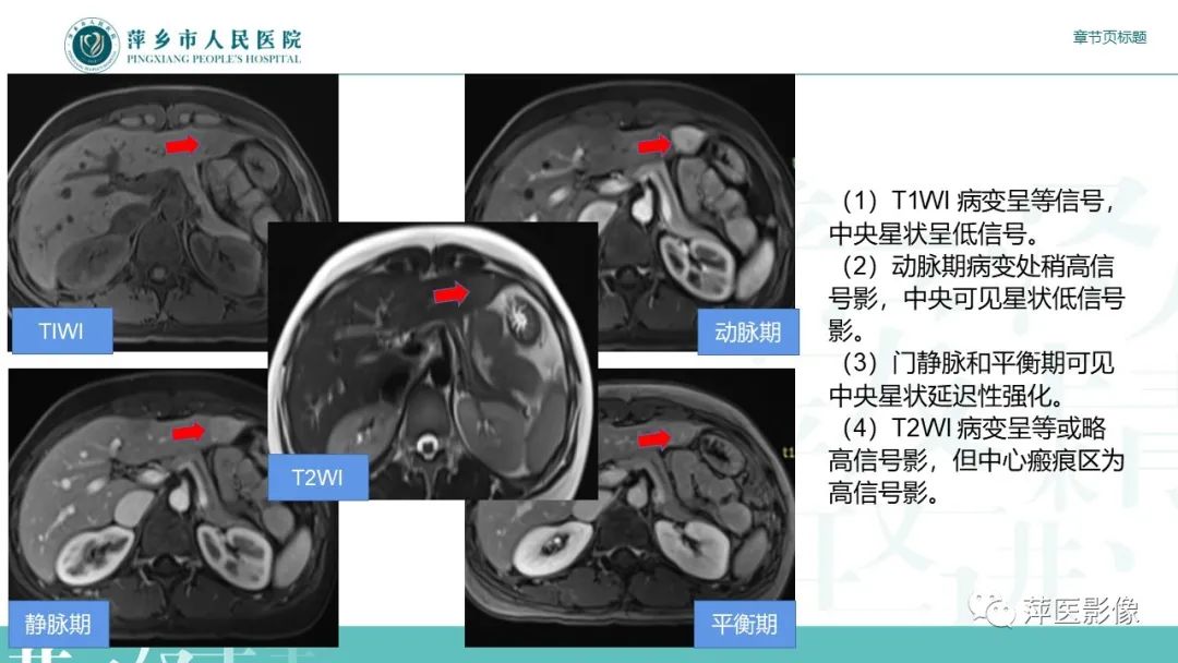 影像PPT - 【PPT】肝脏局灶性结节性增生(FNH)-16
